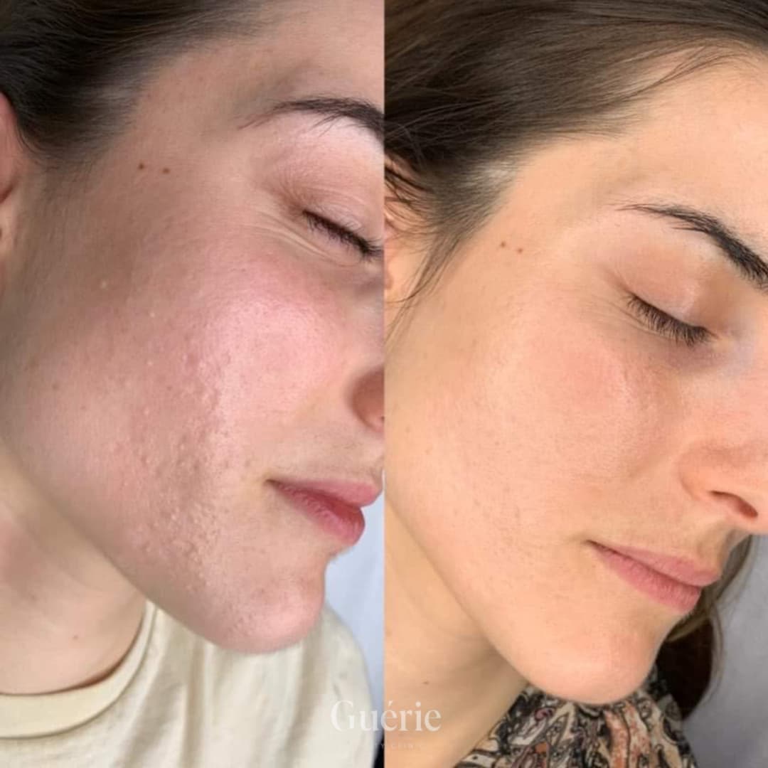 Dermapen/ mezoterapia frakcyjna